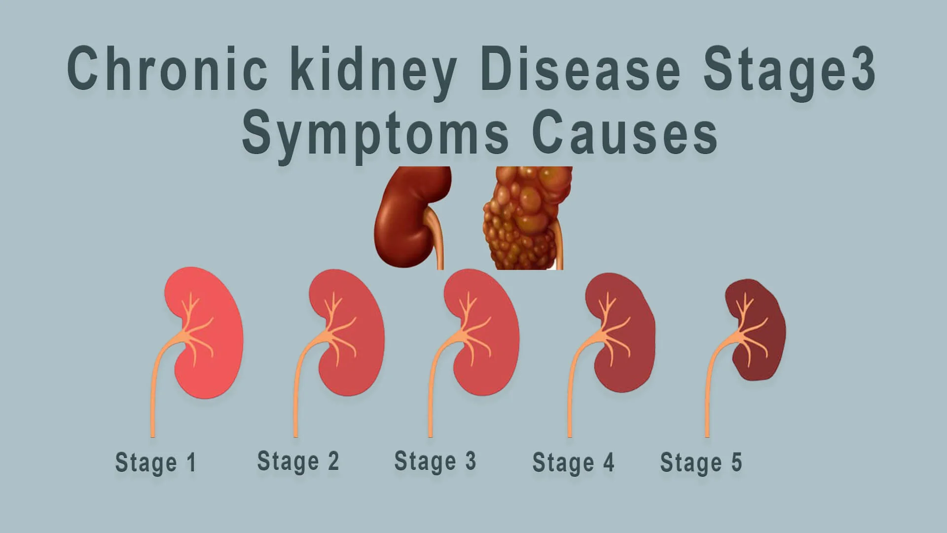 Chronic kidney Disease Stage 3 Symptom/Cause | Gems Vitality