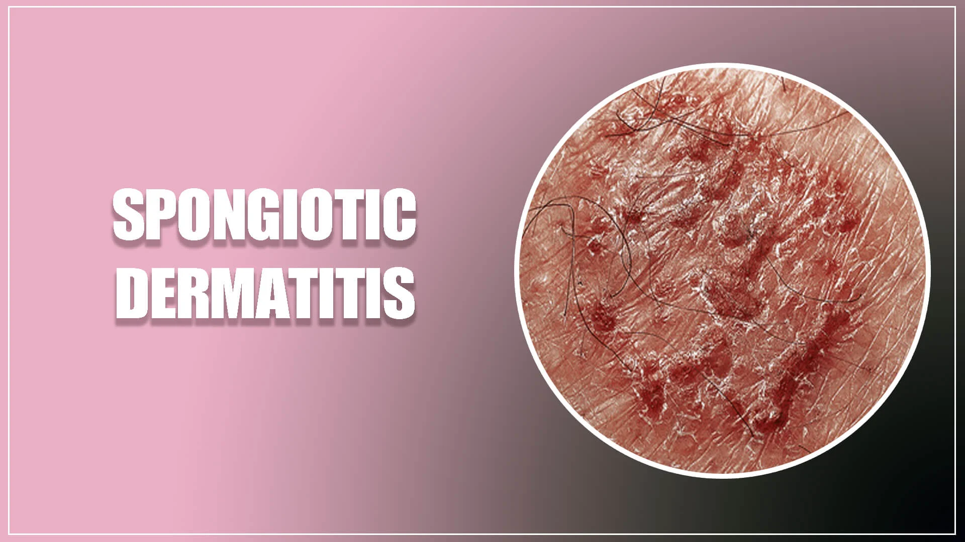 Symptoms and Causes of Spongiotic Dermatitis | Gems Vitality