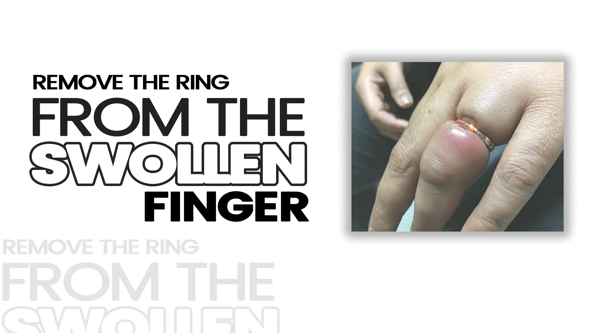 Remove The Ring From The Swollen Finger Gems Vitality